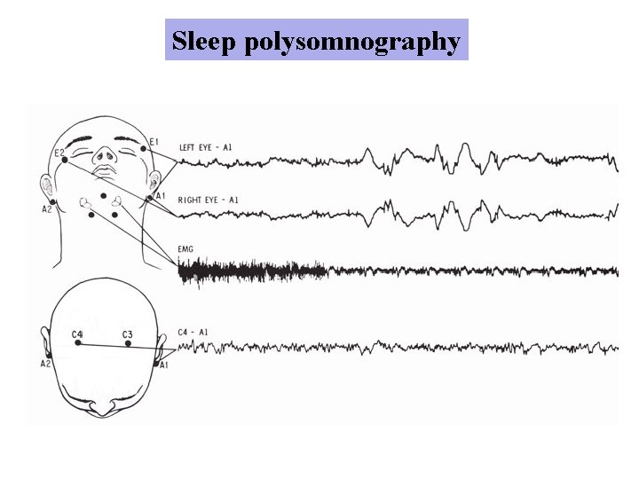 Sleep polysomnography 