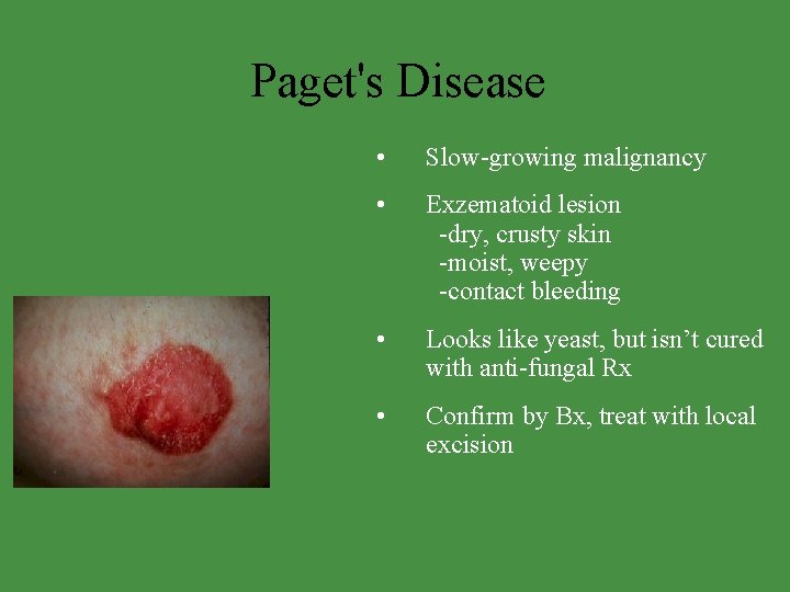 Paget's Disease • Slow-growing malignancy • Exzematoid lesion -dry, crusty skin -moist, weepy -contact