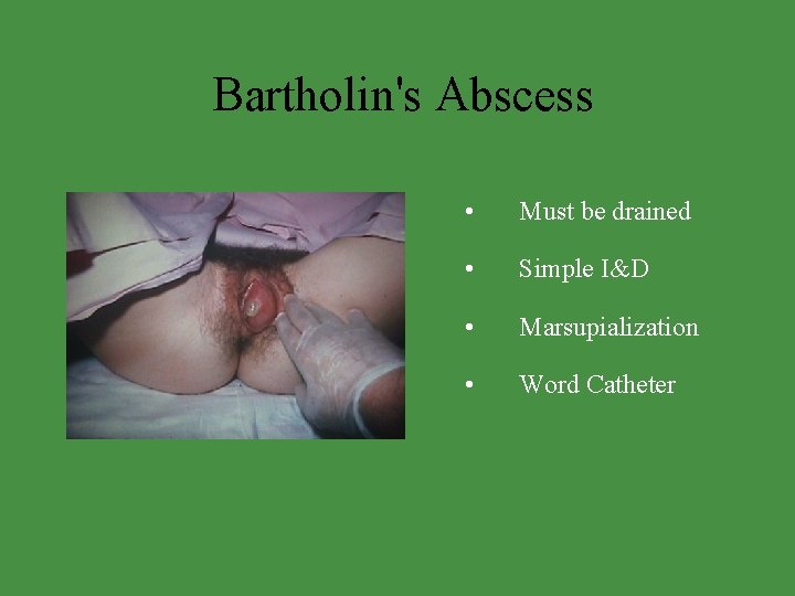 Bartholin's Abscess • Must be drained • Simple I&D • Marsupialization • Word Catheter