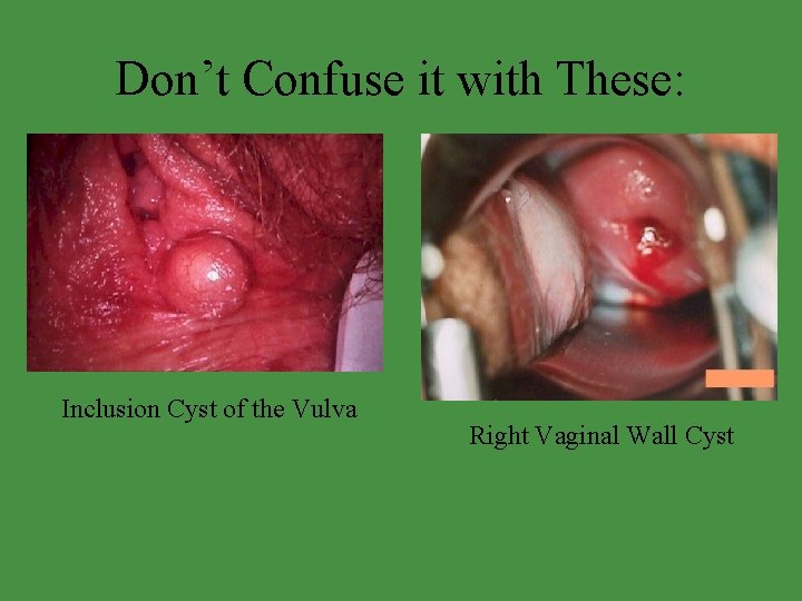 Don’t Confuse it with These: Inclusion Cyst of the Vulva Right Vaginal Wall Cyst