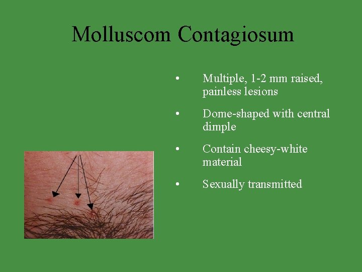 Molluscom Contagiosum • Multiple, 1 -2 mm raised, painless lesions • Dome-shaped with central