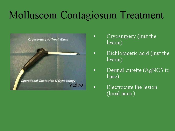 Molluscom Contagiosum Treatment Video • Cryosurgery (just the lesion) • Bichloracetic acid (just the