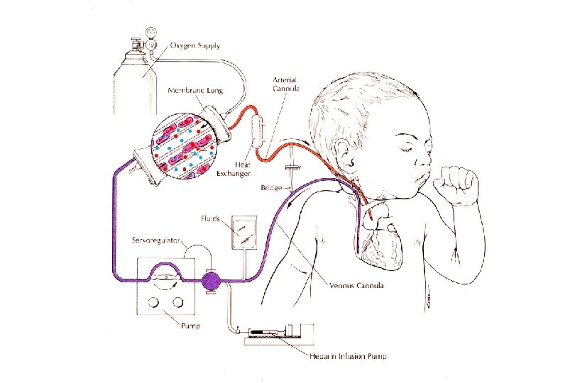 The ECMO Circuit 