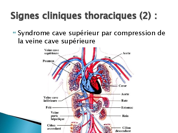 Signes cliniques thoraciques (2) : Syndrome cave supérieur par compression de la veine cave