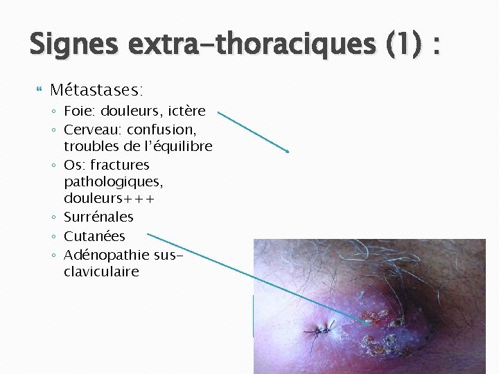 Signes extra-thoraciques (1) : Métastases: ◦ Foie: douleurs, ictère ◦ Cerveau: confusion, troubles de