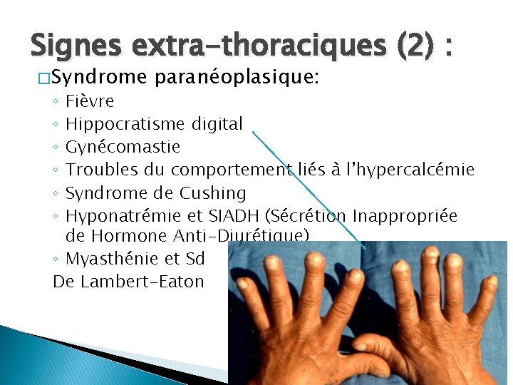 Signes extra-thoraciques (2) : � Syndrome paranéoplasique: Fièvre Hippocratisme digital Gynécomastie Troubles du comportement