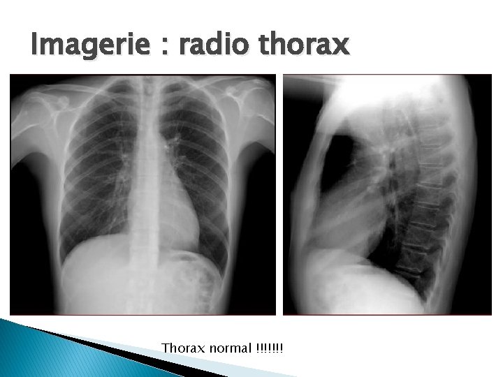 Imagerie : radio thorax Thorax normal !!!!!!! 