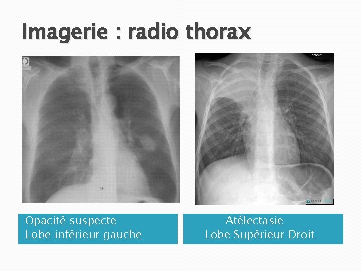 Imagerie : radio thorax Opacité suspecte Lobe inférieur gauche Atélectasie Lobe Supérieur Droit 