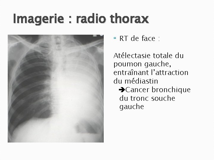 Imagerie : radio thorax RT de face : Atélectasie totale du poumon gauche, entraînant