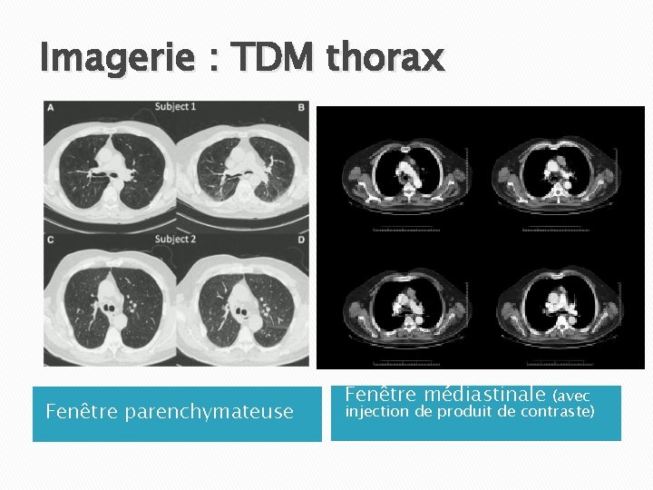 Imagerie : TDM thorax Fenêtre parenchymateuse Fenêtre médiastinale (avec injection de produit de contraste)