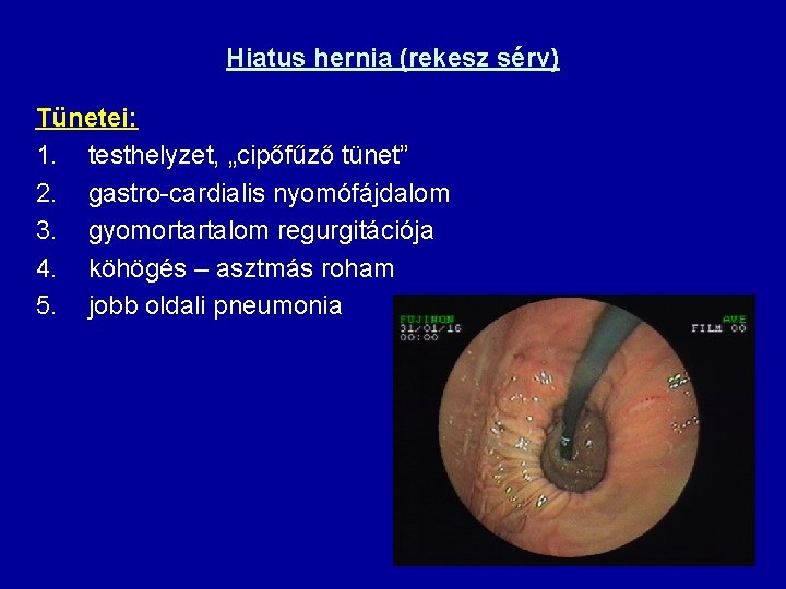 Hiatus hernia (rekesz sérv) Tünetei: 1. testhelyzet, „cipőfűző tünet” 2. gastro-cardialis nyomófájdalom 3. gyomortartalom