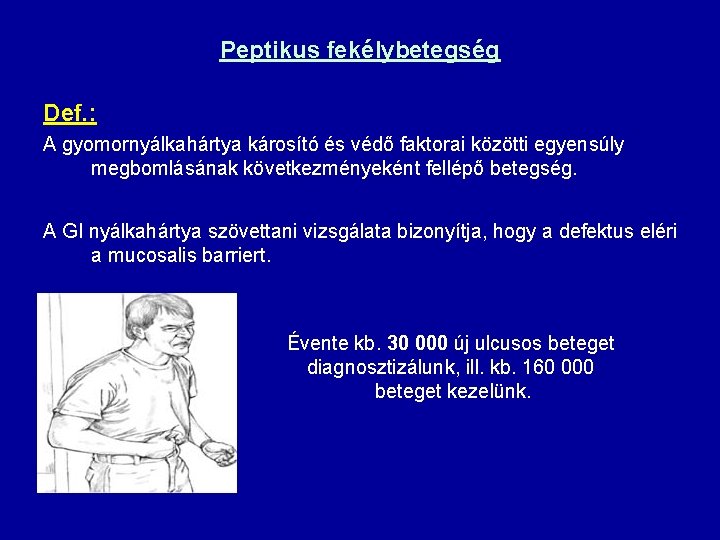 Peptikus fekélybetegség Def. : A gyomornyálkahártya károsító és védő faktorai közötti egyensúly megbomlásának következményeként