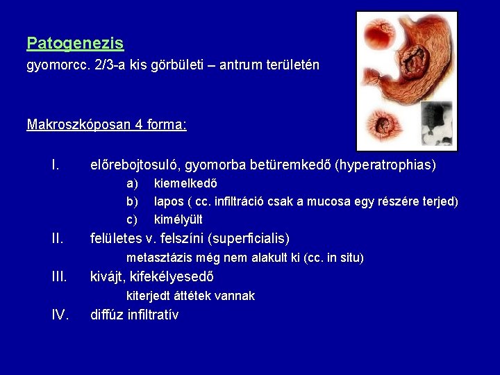 Patogenezis gyomorcc. 2/3 -a kis görbületi – antrum területén Makroszkóposan 4 forma: I. előrebojtosuló,