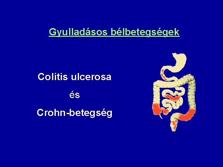 Gyulladásos bélbetegségek Colitis ulcerosa és Crohn-betegség 