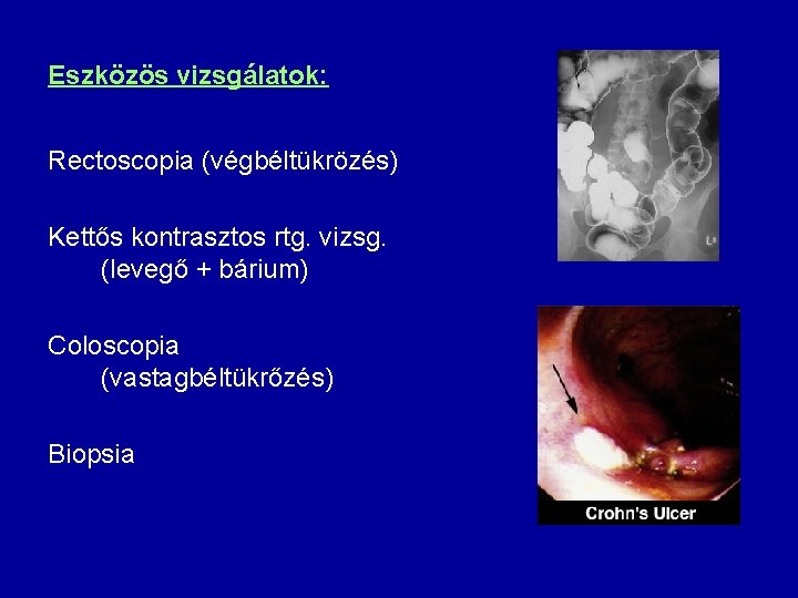 Eszközös vizsgálatok: Rectoscopia (végbéltükrözés) Kettős kontrasztos rtg. vizsg. (levegő + bárium) Coloscopia (vastagbéltükrőzés) Biopsia