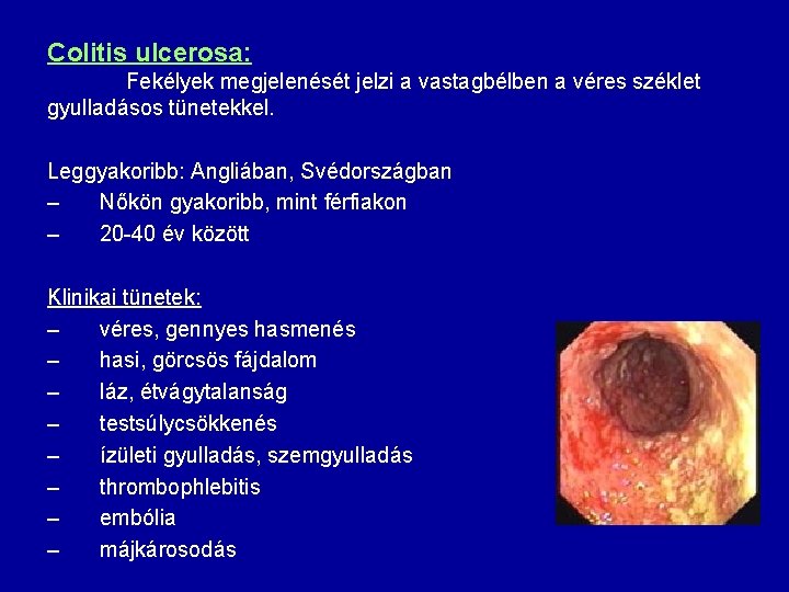 Colitis ulcerosa: Fekélyek megjelenését jelzi a vastagbélben a véres széklet gyulladásos tünetekkel. Leggyakoribb: Angliában,