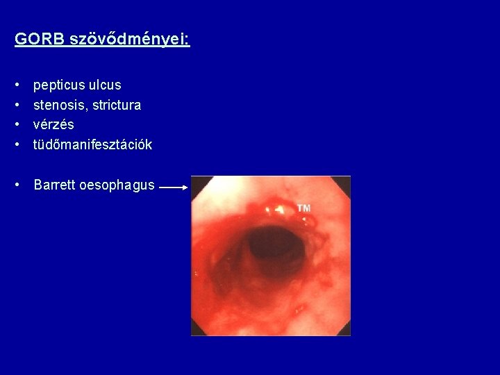 GORB szövődményei: • • pepticus ulcus stenosis, strictura vérzés tüdőmanifesztációk • Barrett oesophagus 