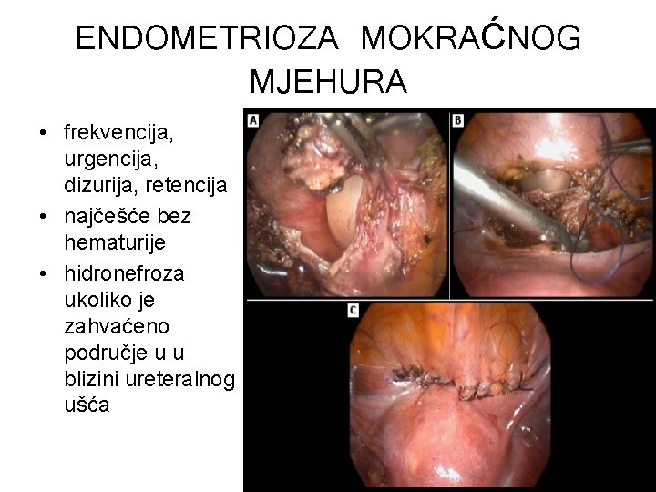 ENDOMETRIOZA MOKRAĆNOG MJEHURA • frekvencija, urgencija, dizurija, retencija • najčešće bez hematurije • hidronefroza