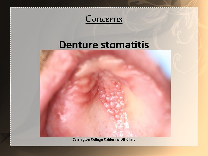 Concerns Denture stomatitis Carrington College California DH Clinic 