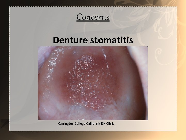 Concerns Denture stomatitis Carrington College California DH Clinic 