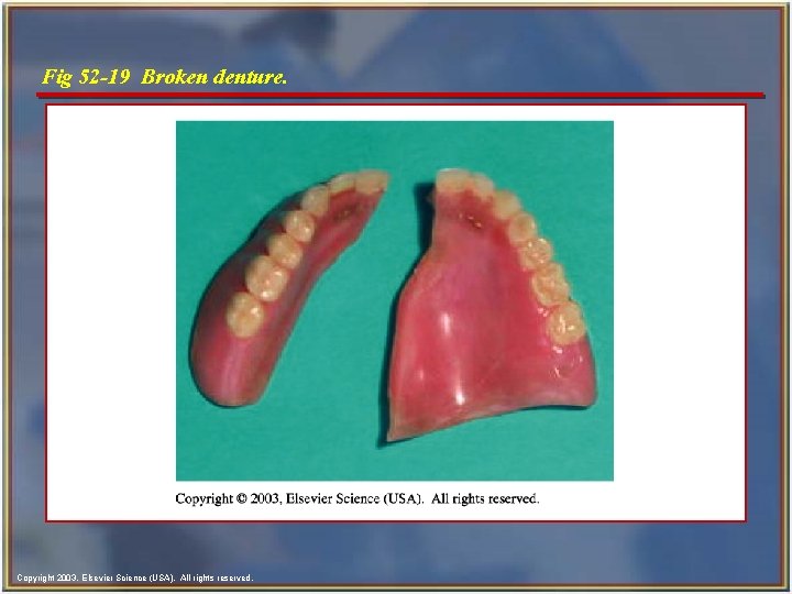 Fig 52 -19 Broken denture. Copyright 2003, Elsevier Science (USA). All rights reserved. 