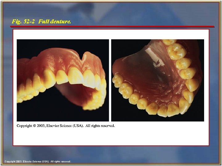 Fig. 52 -2 Full denture. Copyright 2003, Elsevier Science (USA). All rights reserved. 