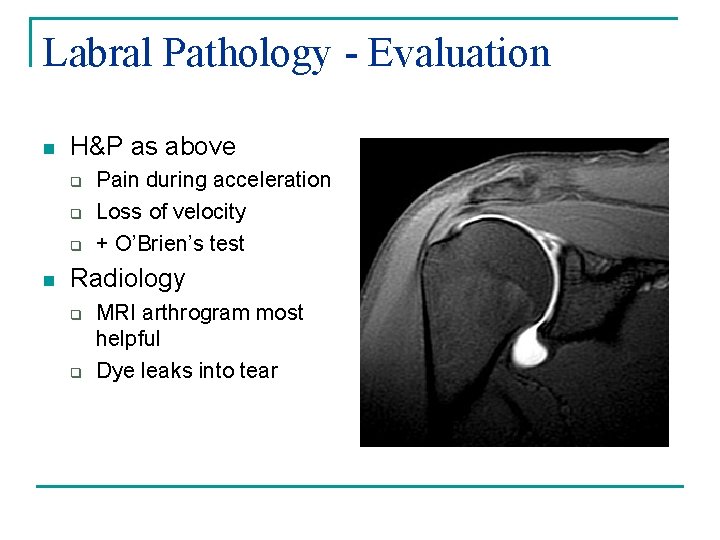 Labral Pathology - Evaluation n H&P as above q q q n Pain during