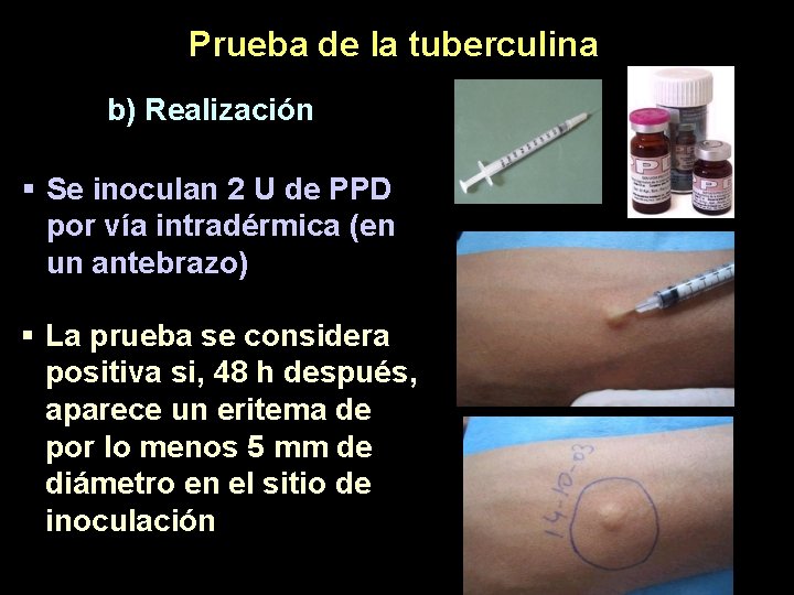 Prueba de la tuberculina b) Realización § Se inoculan 2 U de PPD por