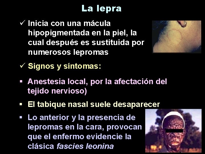 La lepra ü Inicia con una mácula hipopigmentada en la piel, la cual después