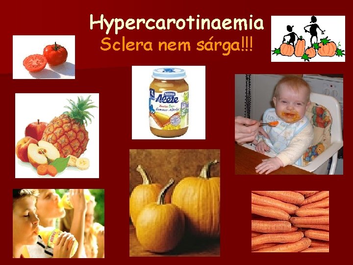 Hypercarotinaemia Sclera nem sárga!!! 
