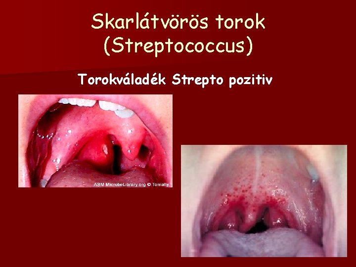 Skarlátvörös torok (Streptococcus) Torokváladék Strepto pozitiv 