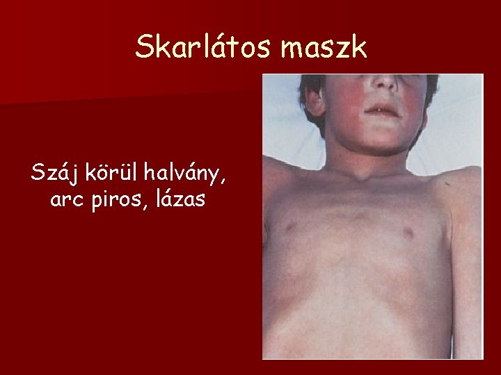 Skarlátos maszk Száj körül halvány, arc piros, lázas 