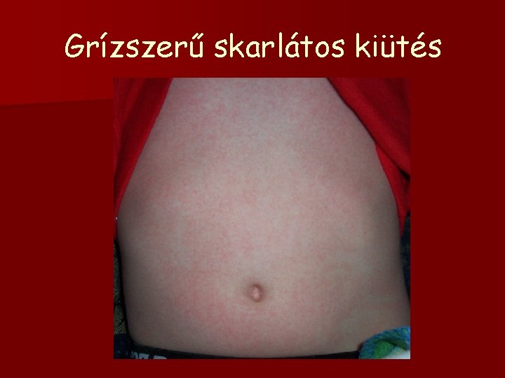 Grízszerű skarlátos kiütés 