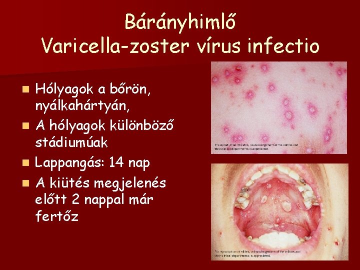 Bárányhimlő Varicella-zoster vírus infectio Hólyagok a bőrön, nyálkahártyán, n A hólyagok különböző stádiumúak n