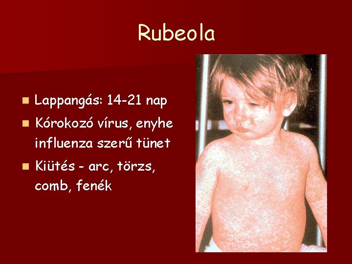 Rubeola n Lappangás: 14 -21 nap n Kórokozó vírus, enyhe influenza szerű tünet n