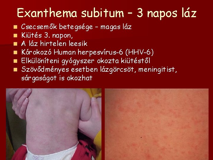 Exanthema subitum – 3 napos láz n n n Csecsemők betegsége – magas láz