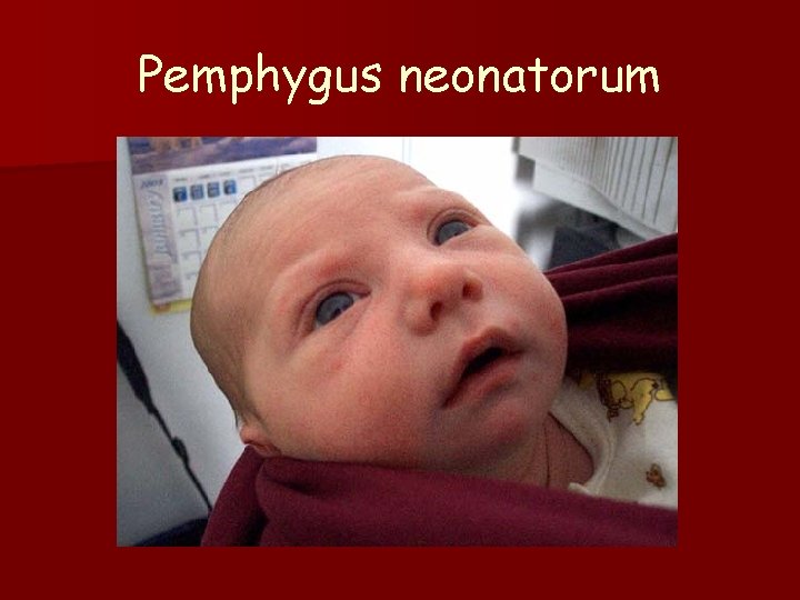 Pemphygus neonatorum 