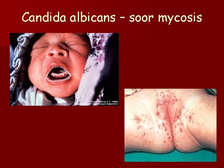 Candida albicans – soor mycosis 