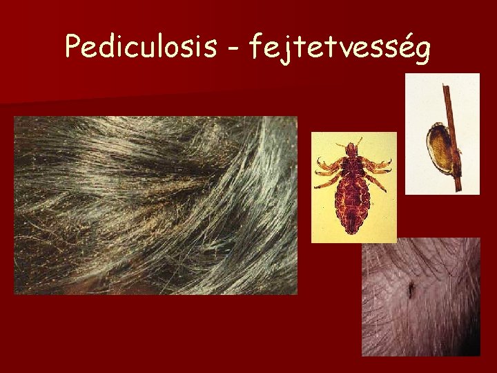 Pediculosis - fejtetvesség 