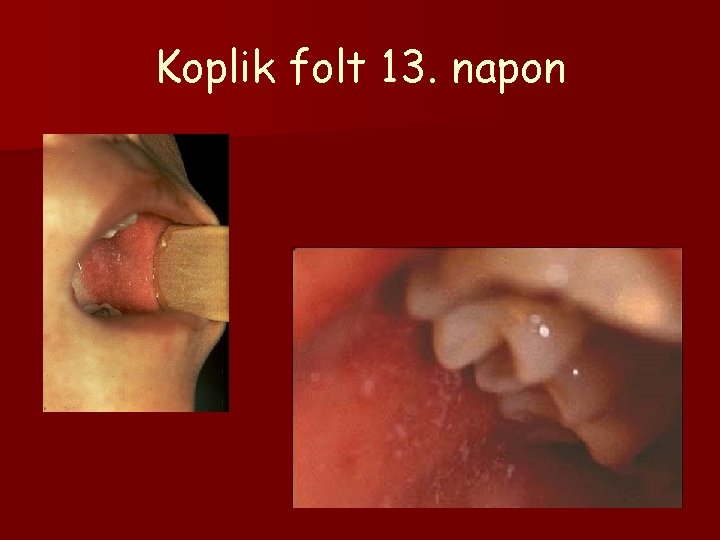 Koplik folt 13. napon 