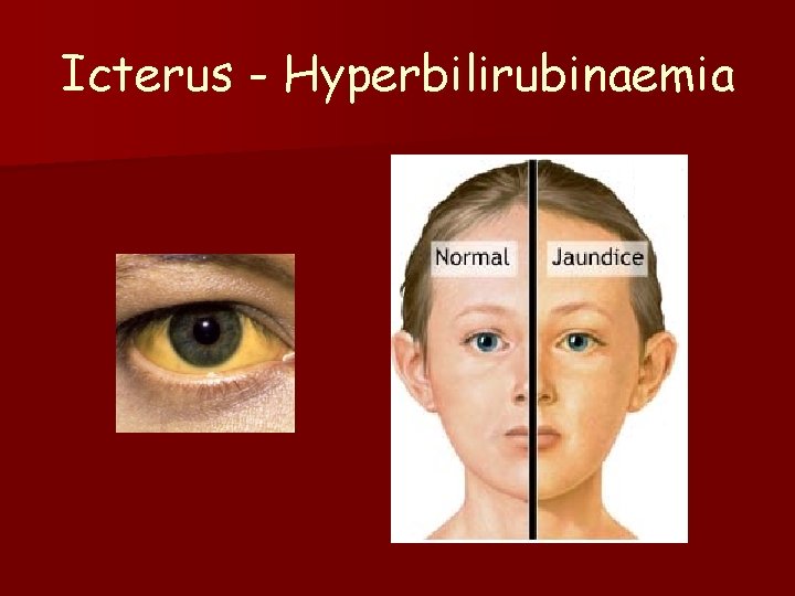 Icterus - Hyperbilirubinaemia 