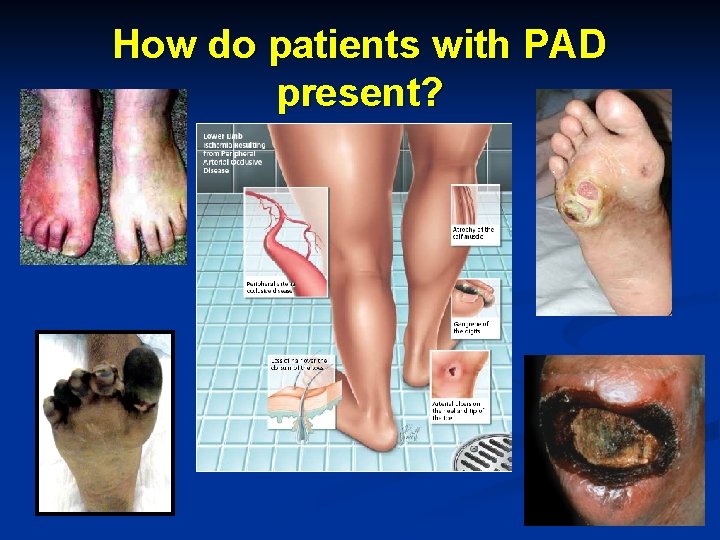 How do patients with PAD present? 
