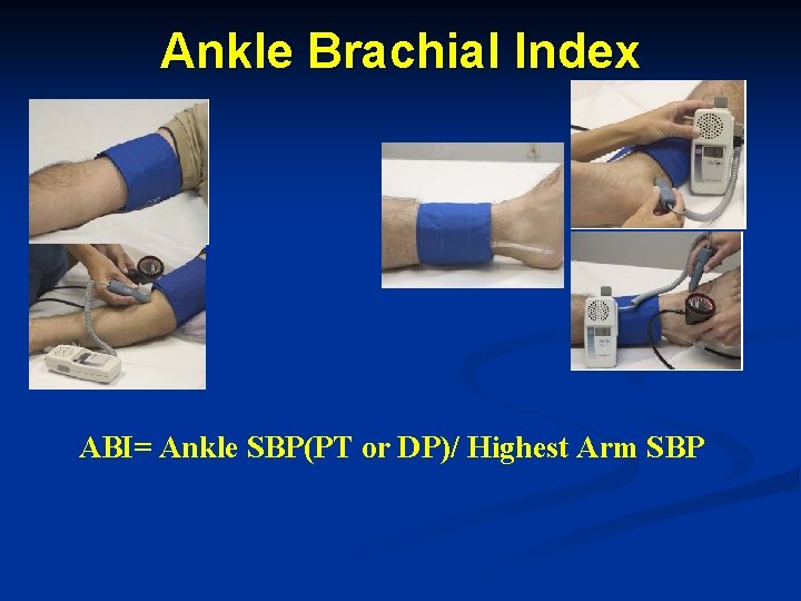 Ankle Brachial Index ABI= Ankle SBP(PT or DP)/ Highest Arm SBP 