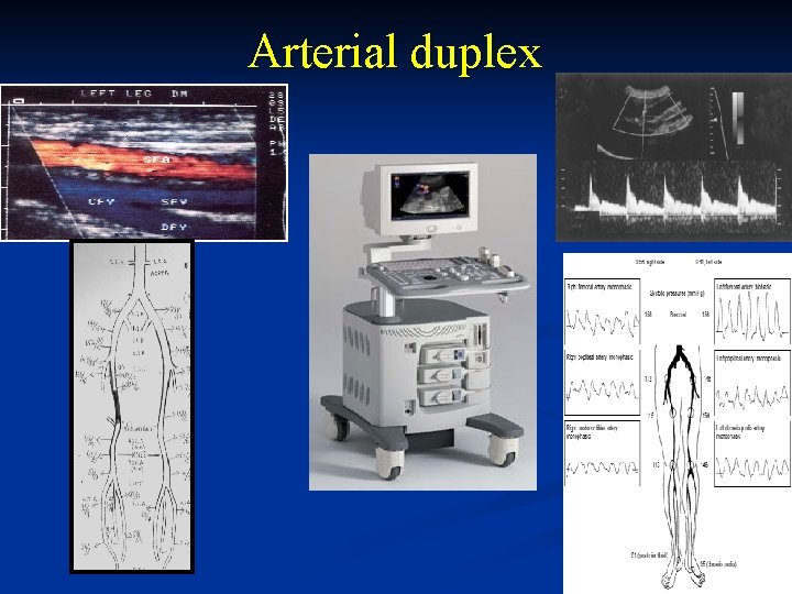 Arterial duplex 