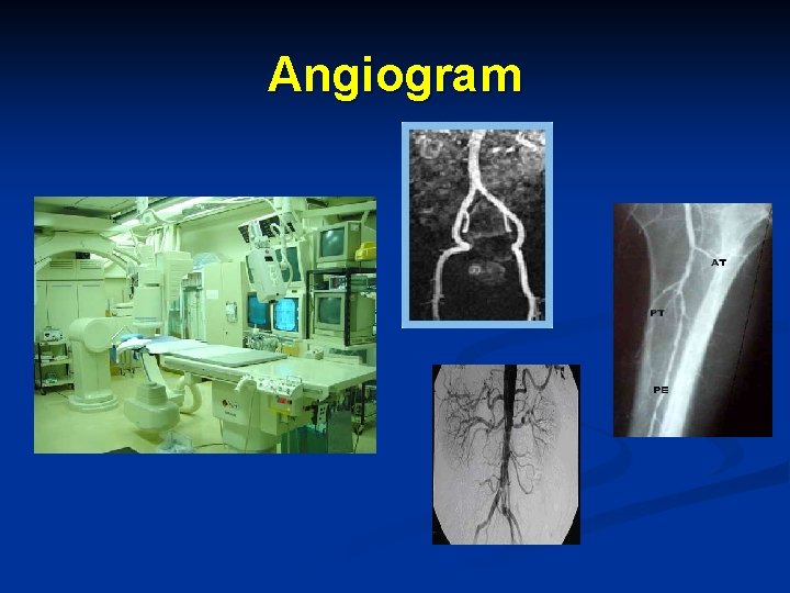 Angiogram 
