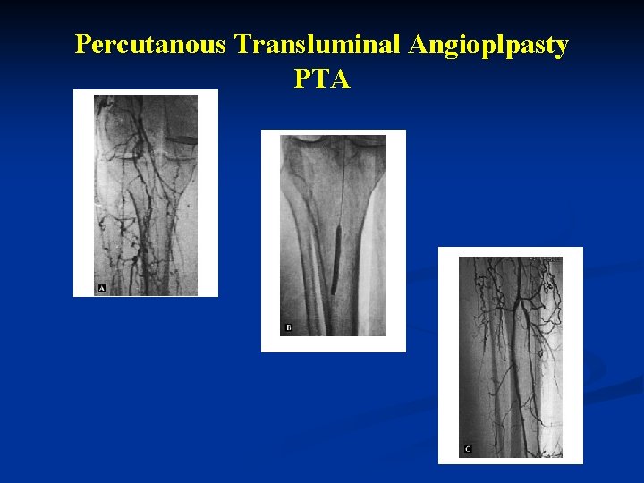 Percutanous Transluminal Angioplpasty PTA 
