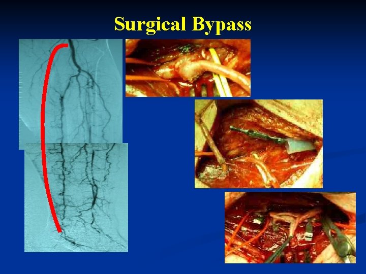 Surgical Bypass 