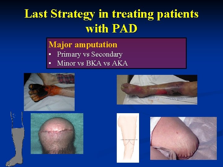 Last Strategy in treating patients with PAD Major amputation • Primary vs Secondary •