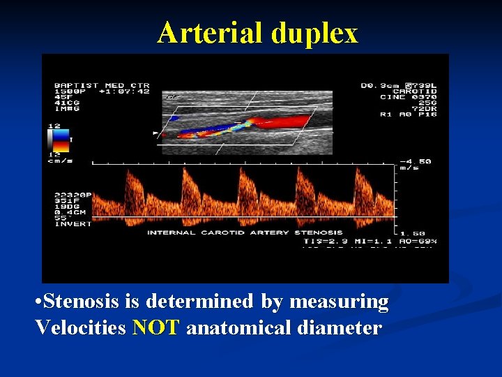 Arterial duplex • Stenosis is determined by measuring Velocities NOT anatomical diameter 