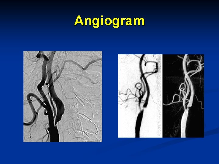 Angiogram 